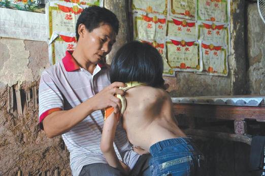 有嚴重脊椎畸形及胸腔隆突病的李文霞。