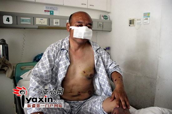 新疆沙灣村民山中撿玉遭棕熊攻擊 鼻子、上嘴唇被咬掉撿回一命（圖）