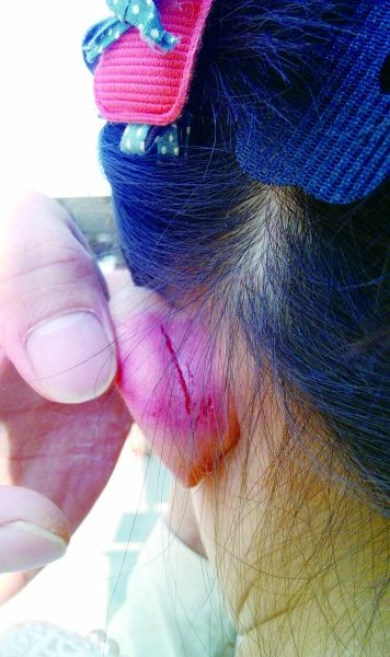 　　女童的耳朵被老師揪裂。圖片由女童家人提供