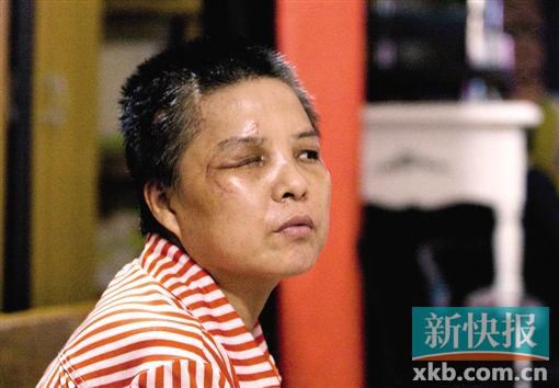 4月初,趙女士遭人搶劫并被打傷,現(xiàn)今右眼失明,頭部被縫100多針。記者 畢志毅/攝