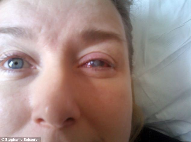 恐怖慎入！隱形眼鏡致英女子摘除眼球
