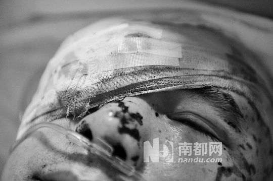 李建新頭部還有被潑硫酸的痕跡，醫(yī)生說(shuō)被砍傷的右眼已經(jīng)失明。 南都記者 田飛 攝