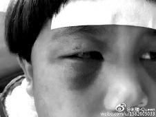 6月2日，網(wǎng)曝渭南市臨渭區(qū)一不滿5歲的女童遭奶奶毆打，眼圈青腫，引起網(wǎng)友關(guān)注，但孩子父母和爺爺均稱是摔倒導(dǎo)致。相關(guān)部門介入調(diào)查發(fā)現(xiàn)確為奶奶毆打所致，鑒于其身體原因已進(jìn)行批評(píng)教育。