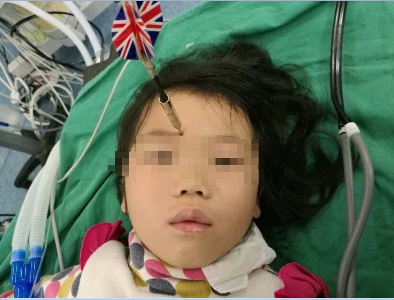 十多公分長的飛鏢穩(wěn)穩(wěn)地 ” 定 ” 在了一名六歲半的女童額頭上，小青一家人凌晨從長順趕到貴醫(yī)附院急診室時，看到如此慘烈的情況，接診醫(yī)生都嚇了一跳。詳細詢問下得知，原來是七歲的哥哥和六歲半的表妹在玩耍時，哥哥不慎將路邊撿來的真飛鏢扎到了妹妹的額頭上。