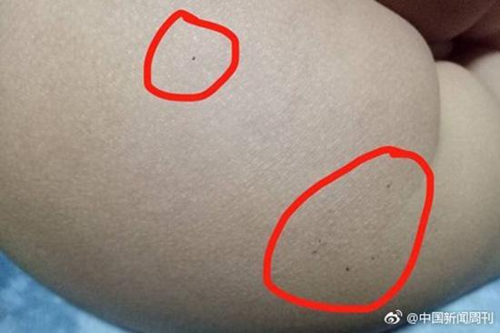 據(jù)多名紅黃藍(lán)(新天地分園)家長(zhǎng)反映，孩子腿部、屁股、腋下出現(xiàn)針眼。