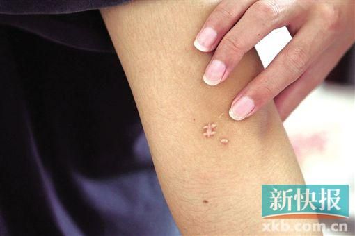 取出針后李星兒手臂留下了傷口。新快報(bào)記者 張國(guó)鋒/攝