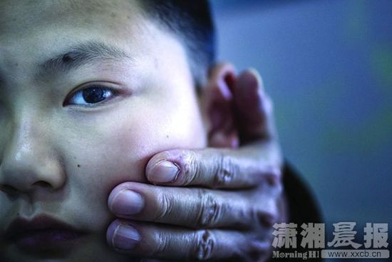 1月13日，小玨的父親心疼地摸著兒子的臉。