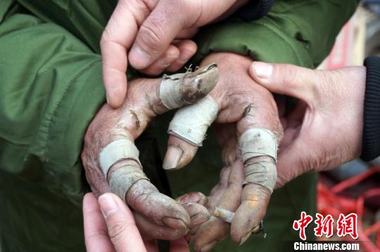 圖為由于常年拾荒，老人雙手布滿傷口。周小云 攝